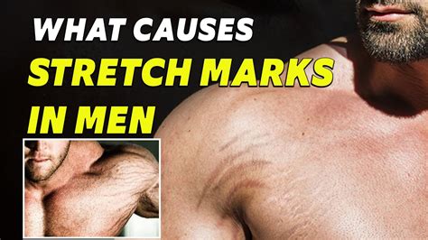 Do Men Have Stretch Marks? Exploring the Myths and Realities of Male Skin