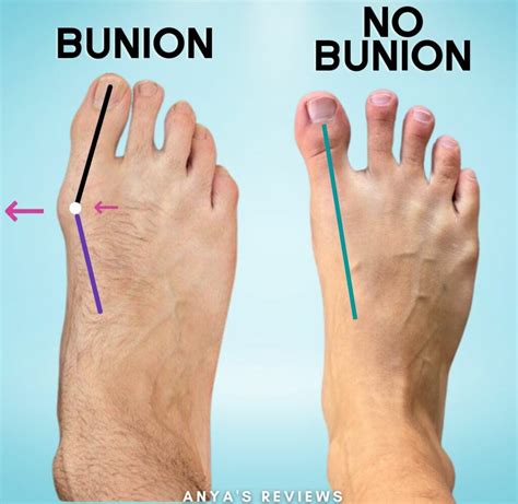 Does Running Make Bunions Worse? Exploring the Footsteps of Foot Health